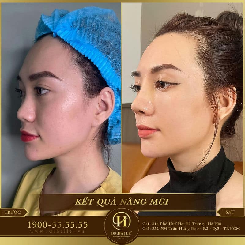 Nâng mũi Demi Tech 6D