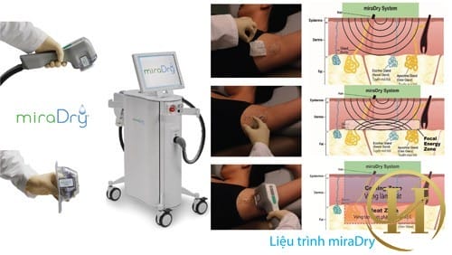 Trị hôi nách bằng công nghệ hiện đại MiraDry