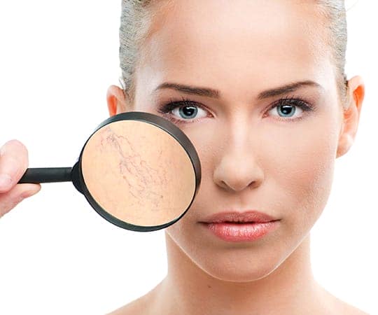 Cách phòng tránh bệnh giãn mao mạch trên da