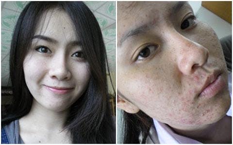 Da nổi mụn chi chít chỉ vì dùng kem làm trắng da dỏm