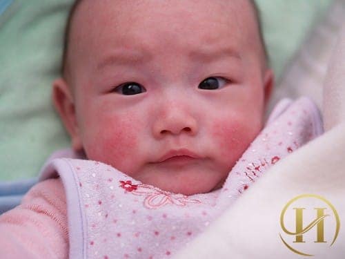 Chàm ở trẻ sơ sinh