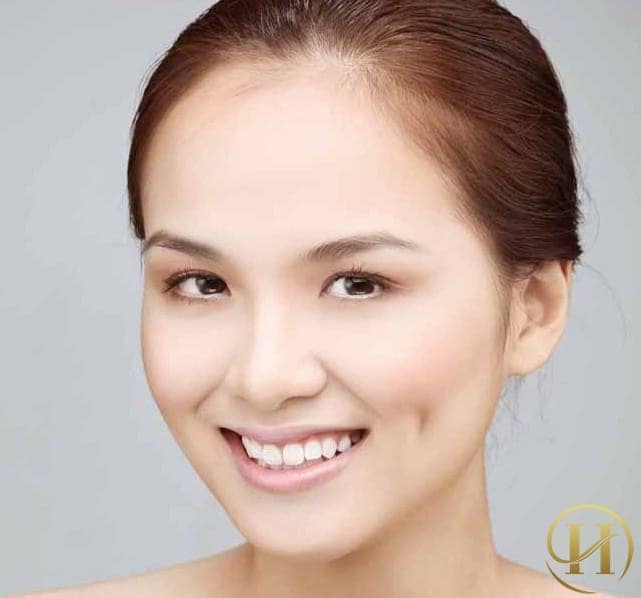 Tạo má lúm đồng tiền