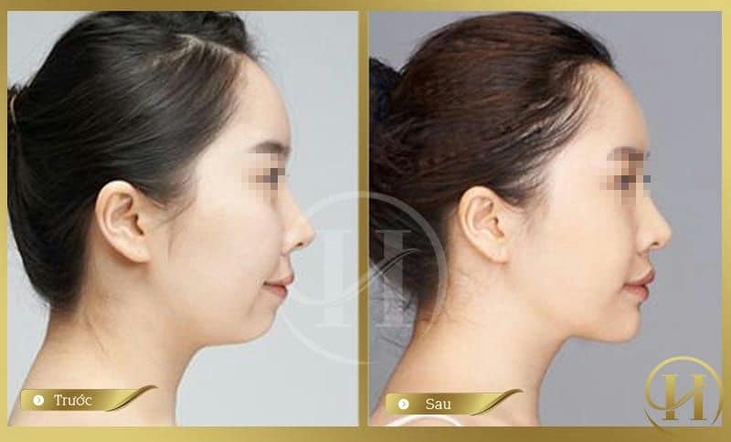 Ảnh trước và sau khi độn cằm