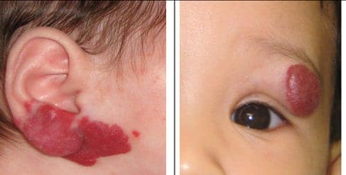 U mạch máu, vết chàm bớt và những điều mà bạn chưa biết