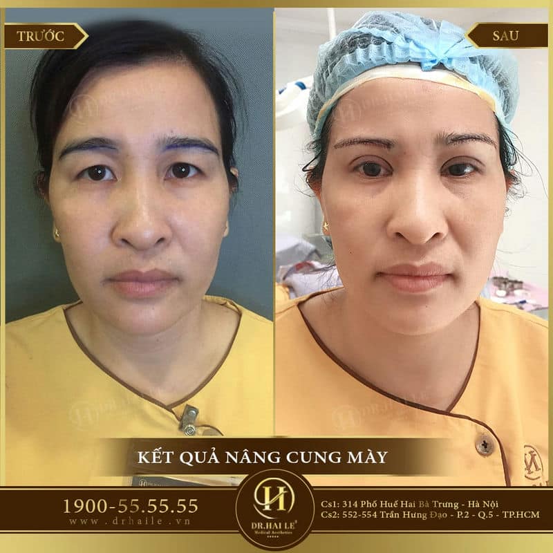 kq nâng cung mày 2