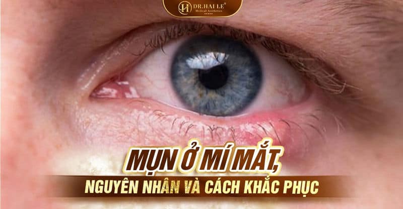 Mụn ở mí mắt, nguyên nhân và cách điều trị?