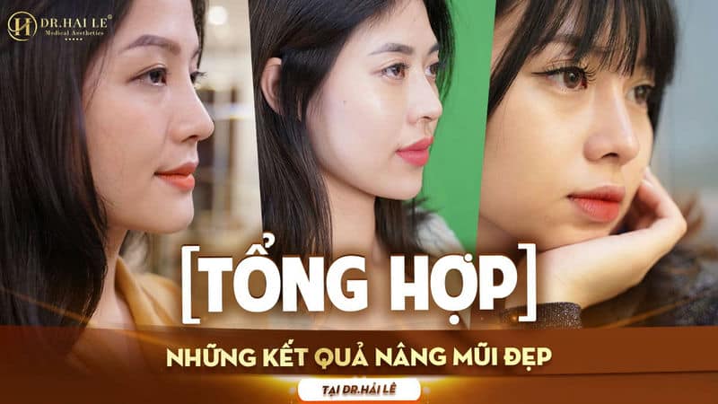Tổng hợp những kết quả nâng mũi đẹp Tại Dr. Hải Lê
