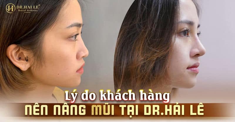 Lý do khách hàng nên nâng mũi tại Dr.Hải Lê