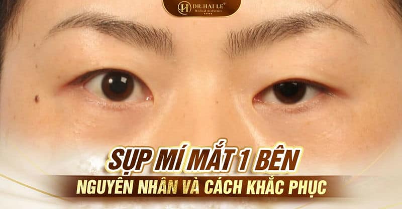 Sụp mí mắt 1 bên, nguyên nhân và cách khắc phục?