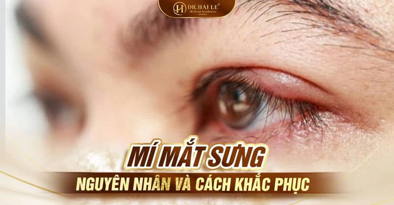 Mí mắt sưng, nguyên nhân và cách khắc phục?