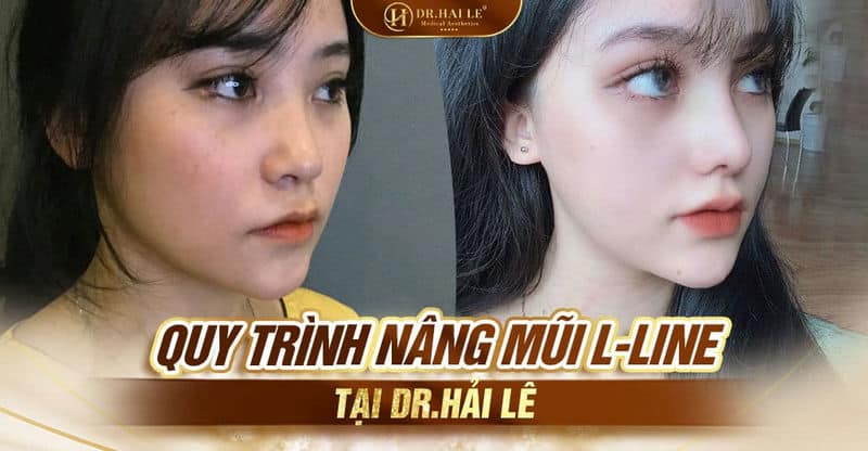 Quy trình nâng mũi L-line tại Dr.Hải Lê?