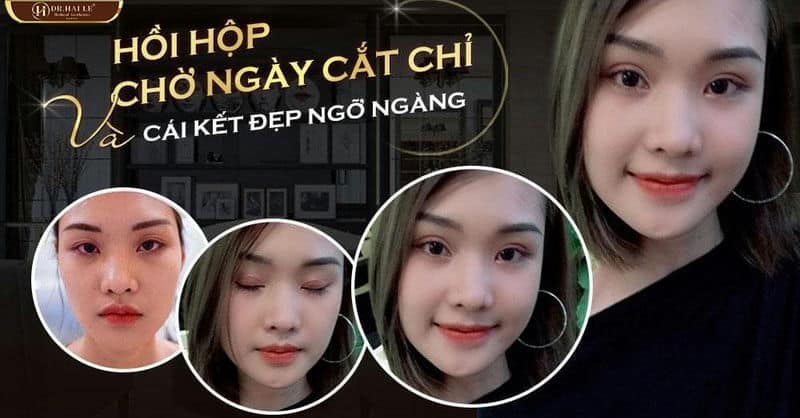 Muốn có mí đẹp đến ngay Dr.Hải Lê