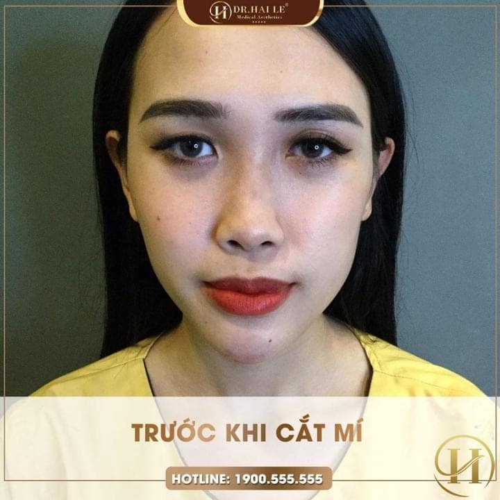 Như Ngọc trước khi cắt mí