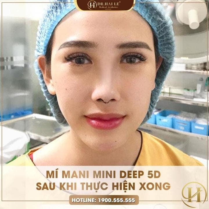 Sau khi cắt mí Như Ngọc