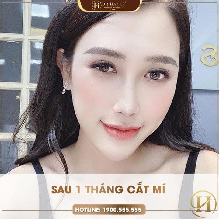 Cắt mí sau 1 tháng Như Ngọc