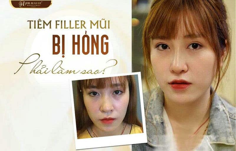 BIẾN CHỨNG TIÊM FILLER MŨI VÀ CÁCH KHẮC PHỤC?