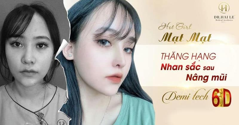Cô gái mạnh tay chi hơn 50 triệu nâng mũi Demi Tech 6D và nhận kết quả bất ngờ!