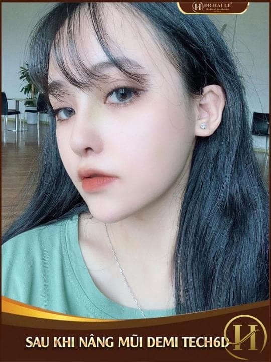 Bích Phương sau khi nâng mũi