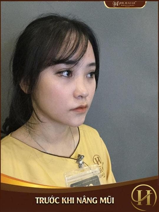 Bích Phương trước khi nâng mũi