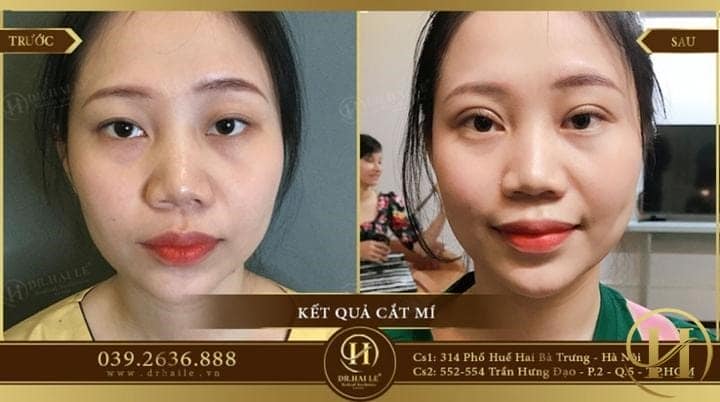 chăm sóc sau cắt mí, chăm sóc sau khi cắt mí mắt, cách chăm sóc sau cắt mí, cách chăm sóc vết thương sau cắt mí, cách chăm sóc sau cắt mí mắt, chăm sóc sau phẫu thuật cắt mí, chăm sóc vết cắt mí, cách chăm sóc cắt mí, chăm sóc sau khi cắt mí, chăm sóc sau cắt mí dưới, chăm sóc sau phẩu thuật cắt mí mắt, chăm sóc vết thương sau cắt mí, kinh nghiệm chăm sóc mắt sau cắt mí, chăm sóc cắt mí mắt
