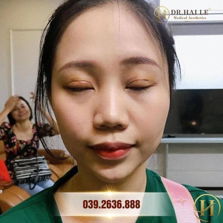 chăm sóc sau cắt mí, chăm sóc sau khi cắt mí mắt, cách chăm sóc sau cắt mí, cách chăm sóc vết thương sau cắt mí, cách chăm sóc sau cắt mí mắt, chăm sóc sau phẫu thuật cắt mí, chăm sóc vết cắt mí, cách chăm sóc cắt mí, chăm sóc sau khi cắt mí, chăm sóc sau cắt mí dưới, chăm sóc sau phẩu thuật cắt mí mắt, chăm sóc vết thương sau cắt mí, kinh nghiệm chăm sóc mắt sau cắt mí, chăm sóc cắt mí mắt