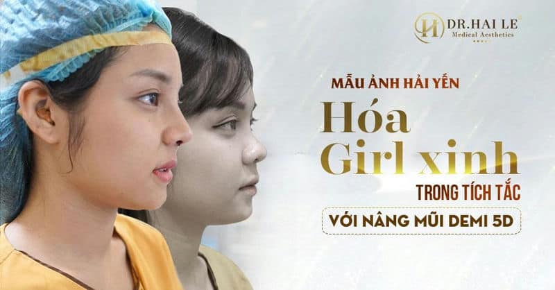 Mẫu ảnh Hải Yến hóa girl xinh trong tích tắc với nâng mũi Demi 5D