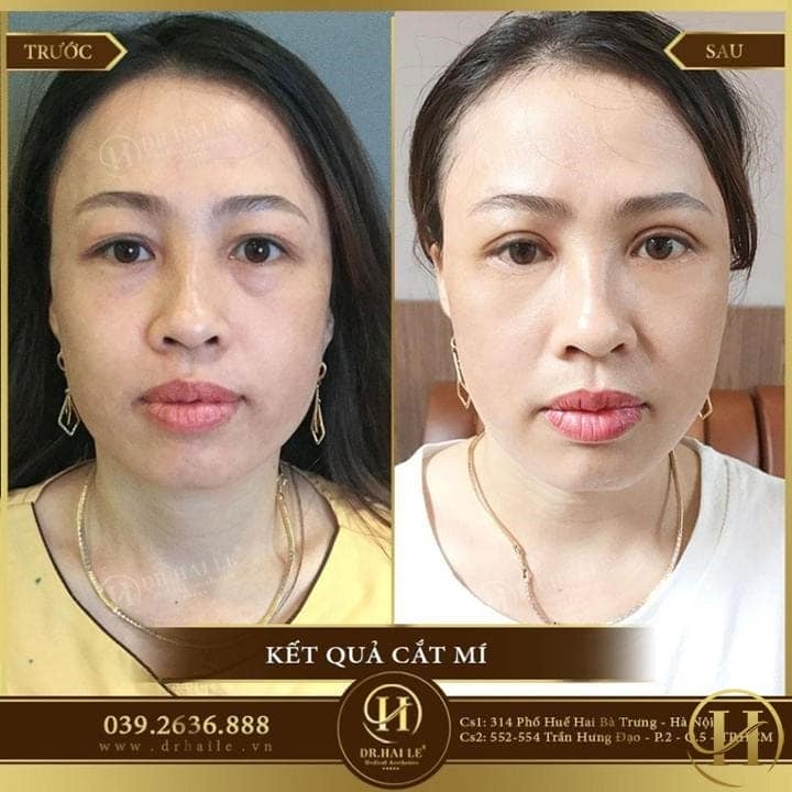 chăm sóc sau cắt mí, chăm sóc sau khi cắt mí mắt, cách chăm sóc sau cắt mí, cách chăm sóc vết thương sau cắt mí, cách chăm sóc sau cắt mí mắt, chăm sóc sau phẫu thuật cắt mí, chăm sóc vết cắt mí, cách chăm sóc cắt mí, chăm sóc sau khi cắt mí, chăm sóc sau cắt mí dưới, chăm sóc sau phẩu thuật cắt mí mắt, chăm sóc vết thương sau cắt mí, kinh nghiệm chăm sóc mắt sau cắt mí, chăm sóc cắt mí mắt