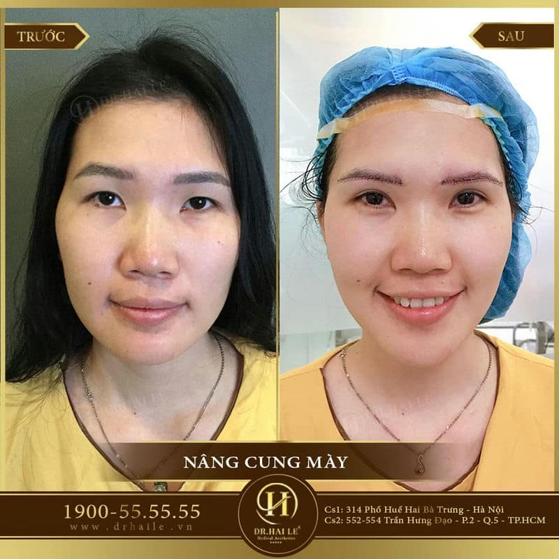 kq nâng cung mày 3
