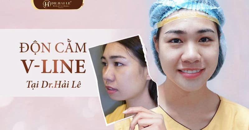 Sở hữu dáng cằm đẹp chỉ sau 45 phút độn cằm V Line