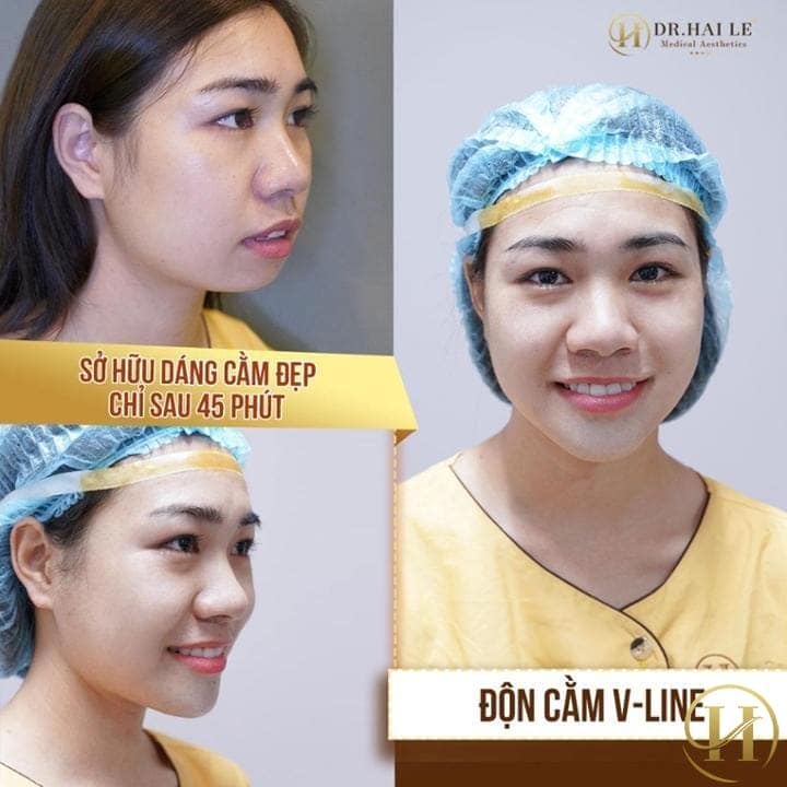 Độn cằm V Line Vũ Diệp