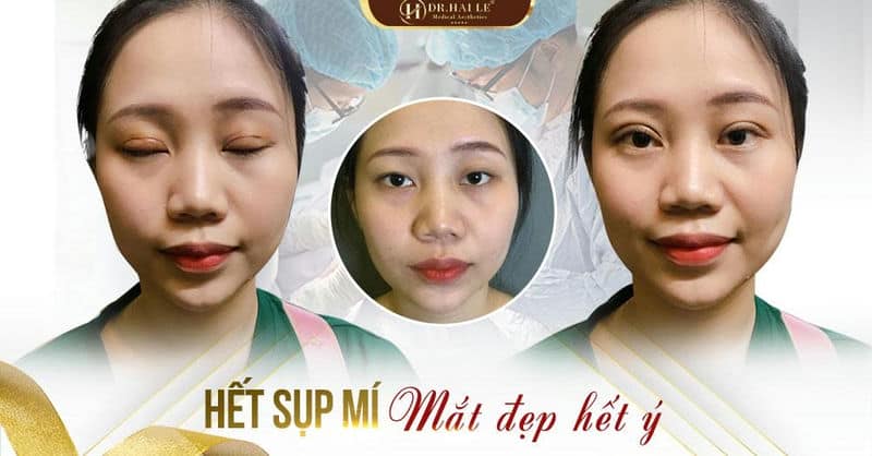 Tiết lộ những lưu ý chăm sóc sau khi cắt mí mắt nhanh lành, không phải ai cũng biết!!!
