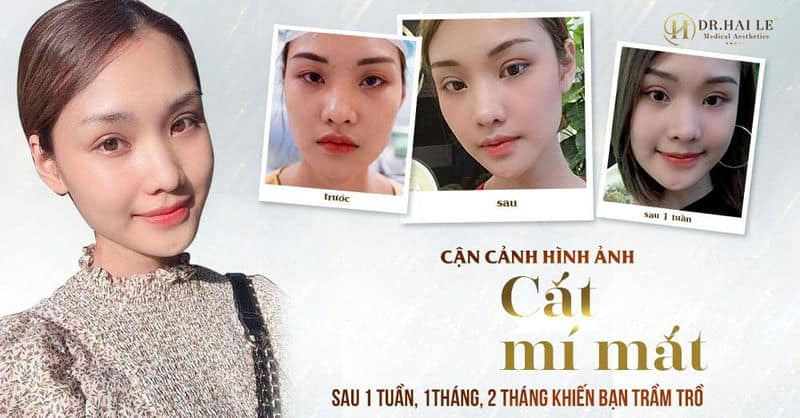 Cận cảnh hình ảnh cắt mí mắt sau 1 tuần, 1 tháng, 2 tháng khiến bạn ngạc nhiên!