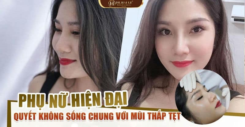 6 tháng nâng mũi Demi Tech 6D chuẩn nhân tướng - Lộc lá “ầm ầm” đến với Hoài Thương!