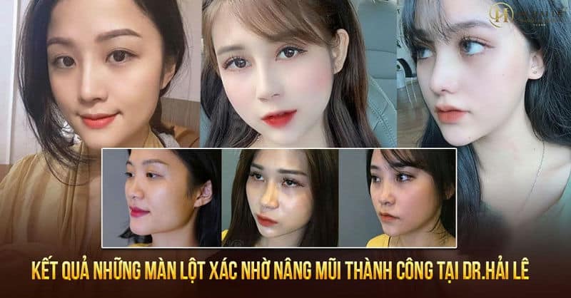 [TỔNG HỢP] KẾT QUẢ NHỮNG MÀN LỘT XÁC NHỜ NÂNG MŨI THÀNH CÔNG TẠI DR.HẢI LÊ
