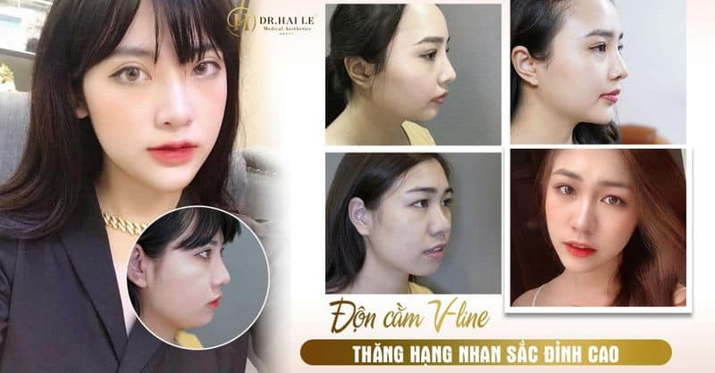 ĐỘN CẰM V-LINE - THĂNG HẠNG NHAN SẮC ĐỈNH CAO