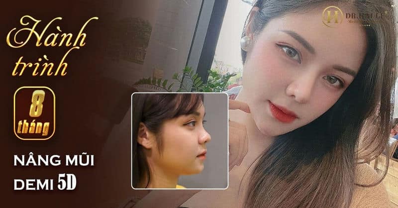 MẪU ẢNH HẢI YẾN VÀ HÀNH TRÌNH 8 THÁNG NÂNG MŨI DEMI 5D