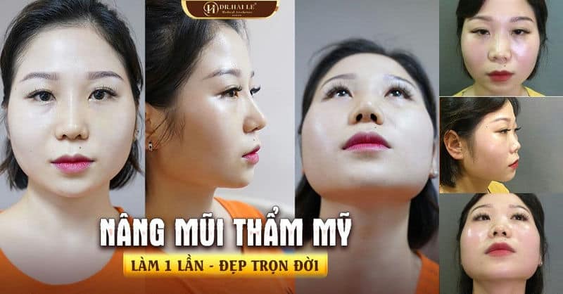 NÂNG MŨI DEMI 5D - KẾT QUẢ SAU 10 NGÀY PHẪU THUẬT