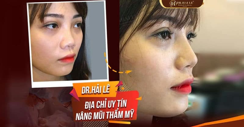 DR.HẢI LÊ - ĐỊA CHỈ NÂNG MŨI UY TÍN
