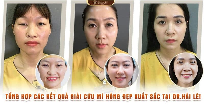 Tổng hợp các kết quả giải cứu mí hỏng đẹp xuất sắc tại Dr.Hải Lê!