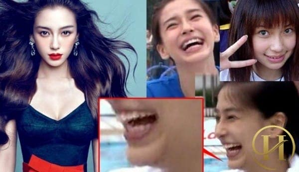 Sau nghi án độn cằm Angela Baby lại bị "soi" dùng sụn silicon nâng mũi