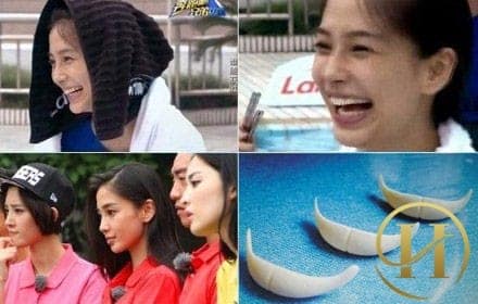 Sau nghi án độn cằm Angela Baby lại bị "soi" dùng sụn silicon nâng mũi