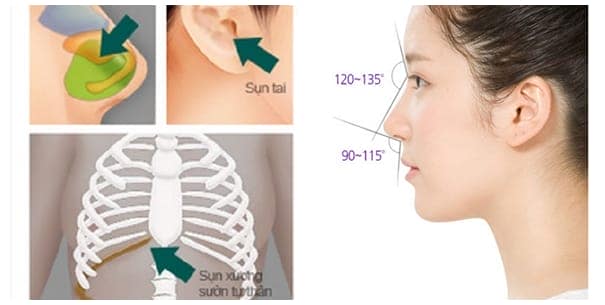 Nâng mũi bọc sụn Hàn Quốc sử dụng sụn tự thân nên rất an toàn cho người sử dụng