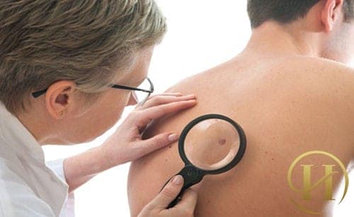 Các dấu hiệu trên nốt ruồi mà bạn phải đi khám ngay lập tức