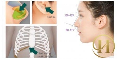 Nhiều khách hàng lựa chọn phương pháp nâng mũi bằng sụn tự thân để cải thiện độ cao cho sống mũi