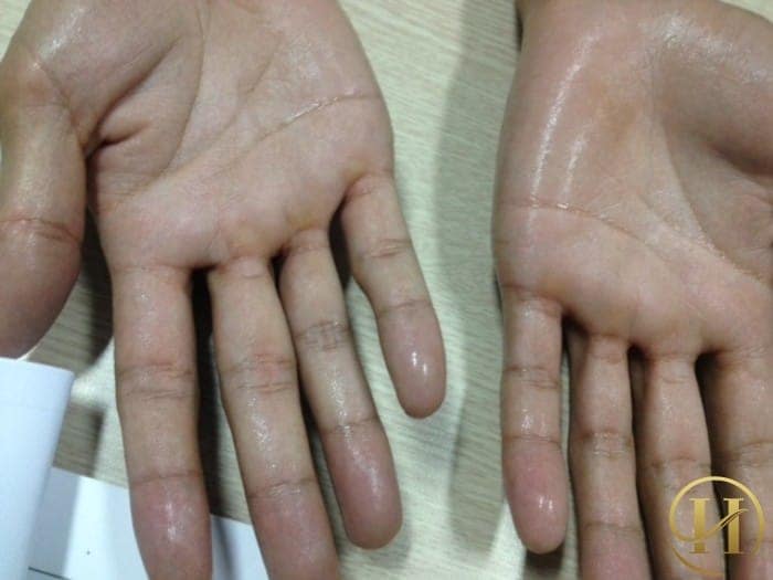 Khi căng thẳng mồ hôi tay sẽ xuất hiện nhiều hơn