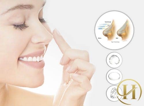 Một chiếc mũi đẹp phải có sống mũi cao và hài hòa với khuôn mặt