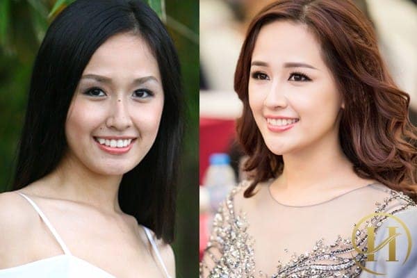 Phần cằm của Mai Phương Thúy ngày càng nhỏ gọn và thanh thoát hơn