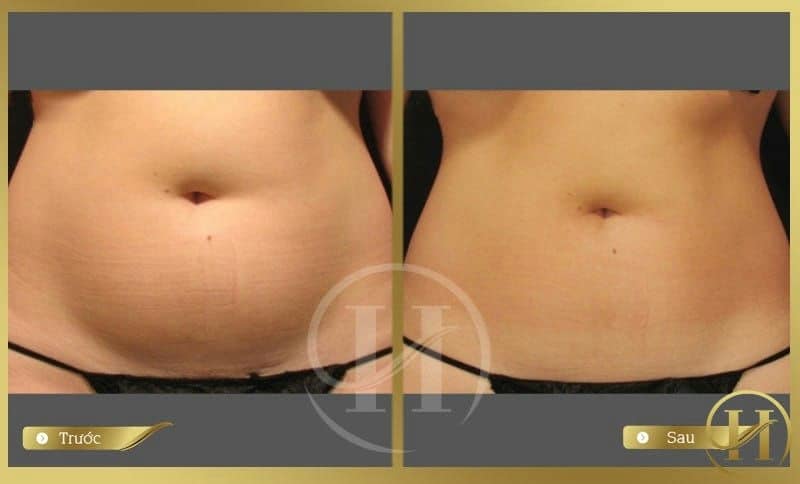 Kết quả trước và sau khi giảm mỡ bụng tại Dr.Hải Lê