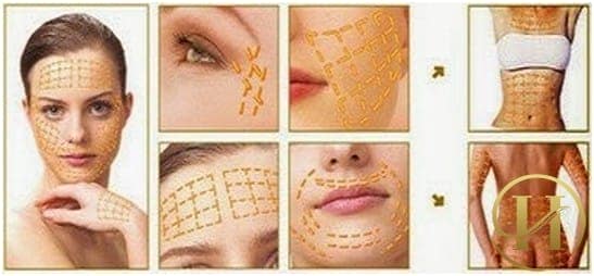 Công nghệ căng da mặt bằng chỉ vàng