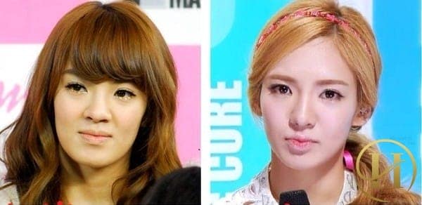 Sau Jessica, đến lượt Hyoyeon (SNSD) đối mặt với tin đồn "dao kéo"